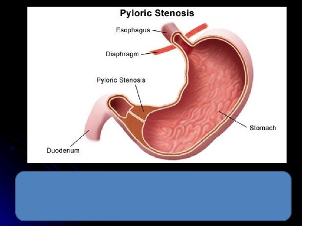Erosion of the stomach: etiology and pathogenesis Erosion of the stomach: etiology and pathogenesis